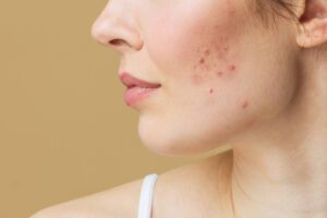 Profile view of a woman's face with acne